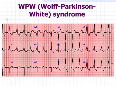 syndrome wolff parkinson white recommandation